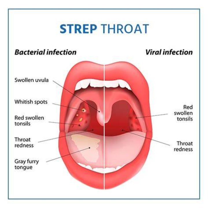 Do and don'ts strep throat?