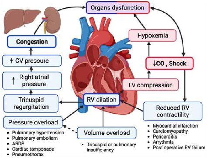What occurs in the event of right ventricular failure?